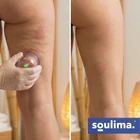 Kép 13/13 - Soulima 12 poharas vákuumos köpölyöző készlet